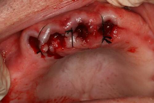 Figure 14 Sutures to assist haemostasis.