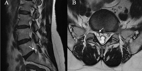 Figure 1 The T2-weighted magnetic resonance imaging (MRI) radiographs are shown in sagittal (A) and axial view (B). The tumor compresses the nerve root to cause right L5 radiculopathy (arrow).