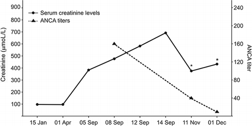 Figure 1.  Serum creatinine levels and ANCA titer on different occasions. Note that creatinine levels were in the normal range before starting carbimazole (01 April). Immunologic remission was achieved after carbimazole withdrawal (ANCA titer non-detectable).Note: *Patient on intermittent renal replacement therapy.