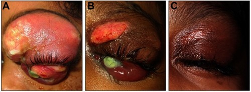 Figure 3 (A) Clinical improvement after three days. (B) Resolution of proptosis, chemosis and edema after adjuvant intravenous corticosteroid. (C) The palpebral could close after three weeks’ therapy with antibiotics combination and corticosteroid.