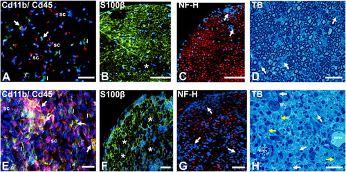 Figure 4. Spontaneous autoimmune peripheral polyneuropathy in adult female Cd86-/- NOD mice. Representative photomicrographs of axial cryostat 10 µm and glutaraldehyde-fixed, osmium tetroxide post-fixed, epoxy resin-embedded, toluidine blue-stained 1 µm sciatic nerve sections from SAPP-affected adult female Cd86-/- NOD mice at 22 weeks (early phase, 2 weeks after symptomatic onset; A-D) and 40 weeks (maximum severity plateau phase, 18 weeks after symptomatic onset, E-H) of age are shown. At 22 weeks of age, there is early infiltration of Cd11b+ (red) Cd45+ (green) leukocytes, consistent with monocytes (white arrows), as well as Cd11b- Cd45+ lymphocytes (l) into the endoneurium, as shown in A. Cd11b + Cd45- cells, consistent with Schwann cells (sc) also observed. Foci of demyelination (asterisk, B) and reduction in axonal density associated mononuclear cell infiltration (white arrows, C) are seen during the early phases of SAPP, supported by epoxy resin-embedded sections showing mononuclear cellular infiltrates (white arrows, D) with normal appearing axons.At 40 weeks of age, there is more diffuse multi-focal infiltration of Cd11b + CD45+ monocytes/macrophages (white arrows) associated with Schwann cell (sc) proliferation and increased numbers of lymphocytes (l) in the endoneurium, as shown in E . This is associated with multi-focal demyelination (asterisk, F) and reduction in axonal density (white arrows, G). Mononuclear cell infiltration, associated with completely demyelinated axons (white arrows) and demyelinated axons surrounded by concentric layers of Schwann cell membranes (i.e. onion bulbs, yellow arrows), indicative of repeated demyelination-remyelination, is shown in H. Endoneurial microvessels (emv) with perivascular mononuclear cells and an axon undergoing Wallerian degeneration (Wd) are also shown. S100β: marker of myelinating Schwann cell membranes; NF-H: Neurofilament-heavy chain, marker of axon intermediate filaments, TB: toluidine blue. Scale bars: A-C = 100 µm and D-H = 50 µm.