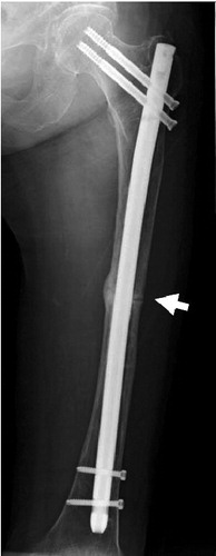 Figure 2. Case 1. Reduced fracture gap of the left femur (arrowheads) 1 year postoperatively.