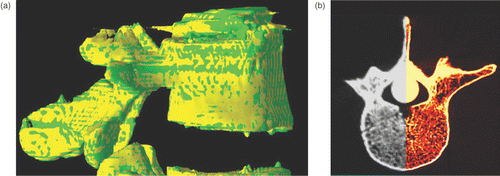 Figure 3. (a) A 3D display of L4 after registration (case 34). Note the overlapping “zebra-like” pattern between the reference volume isosurface (yellow) and the transformed volume isosurface (green) created when the two surfaces coincide. This pattern indicates that the registration is better than the smallest image element (voxel) in the volumes. (b) A 2D overlay axial view where the gray (left) side of the vertebra is the reference volume and the red (right) side is an overlay of the transformed volume on the reference volume. Note the close match between all the condensed areas of the vertebra (case 34). [Color version available online.]