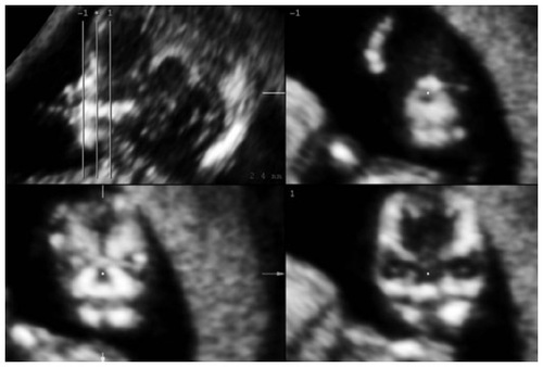 Figure 1 Parallel coronal views of the fetal face showing the retronasal triangle.