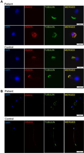Figure 4 (A) Immunofluorescence analysis of nasal cilia cell of the patient and healthy control, showing presence of outer dynein arm protein DNAH5 and absence of the inner dynein arm protein DNAH2 in the patient. Scale bar, 20μm. (B) Immunofluorescence staining of sperms from the patient and the healthy control with α-tubulin antibodies (green) and DNAH2 (red), a marker for MMAF phenotype. DNAH2 is absent in the sperms from the patient. Scale bar, 20μm.