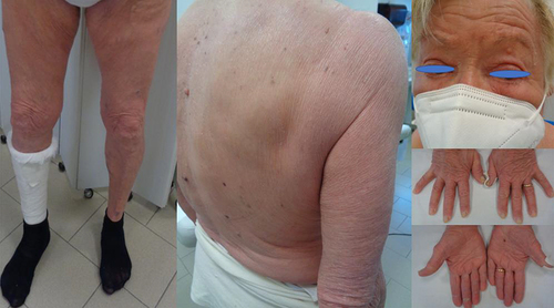 Figure 3 Diffuse erythema with scaling covering approximately 60% of BSA, onychodystrophy, ectropion, mild palmo-plantar hyperkeratosis.