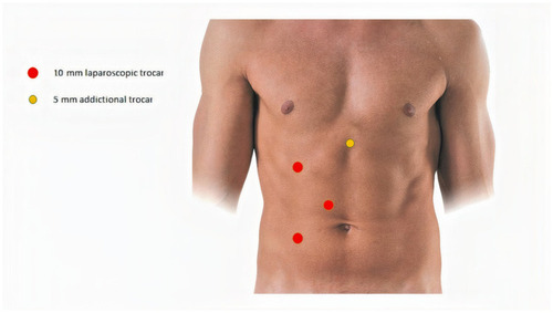 Figure 1 Conventional laparoscopic pyeloplasty trocars’ placement.