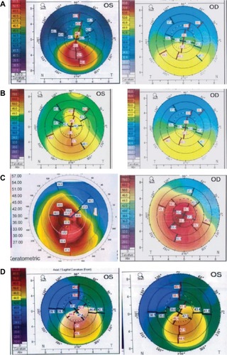 Figure 1 Preoperative (left), and postoperative topographies (right) after femtosecond-assisted intrastromal corneal graft surgery (A–D) showing a kind of “regularization” of the corneal surface postoperatively in study cases 1–4.