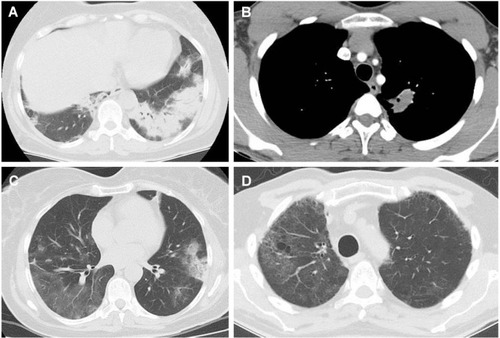Figure 1 Thorax CT manifestations of organizing pneumonia cases. Consolidation (A), mass like lesion (B), ground glass opacity (C), cavity (D).