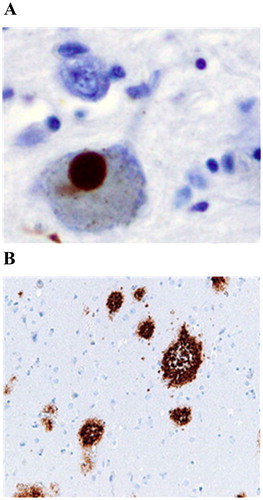 Figure 4. (A) Immunohistochemistry of α-syn showing positive staining (brown) of an intraneural Lewy body in the Substantia nigra in Parkinson’s disease [Citation58]; (B) High magnification micrograph of cerebral amyloid angiopathy with senile plaques in the cerebral cortex consistent of β-amyloid, as may be seen in Alzheimer’s disease [Citation59].