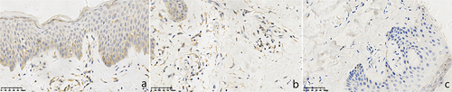 Figure 4 Expressions of TLR9 in chronic eczema lesions and the perilesional normal skin at the edge (SP *400). (a) Epidermic of skin lesion. (b) Dermis of skin lesion. (c) Perilesional normal skin. (a) A few TLR9+ cells with brown cytoplasm were observed in the epidermal of chronic eczema lesions. (b) A few TLR9+ cells with brown cytoplasm were observed in the dermal papillary layer of chronic eczema lesion. (c) Few TLR9+ cells with brown cytoplasm were observed in both epidermal and papillary layer of perilesional normal skin of the lesion.