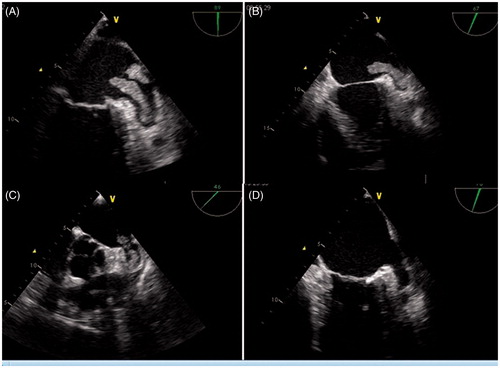 Figure 2. Transeosophageal echocardiography images performed one week intervals showing complete lysis of the giant thrombus in 6-weeks follow-up (A-D).