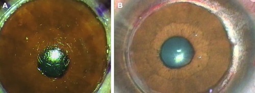 Figure 1 Difference between type 1 and type 2 big bubbles.