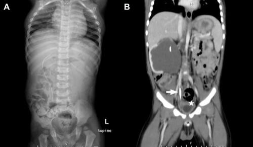 Figure 1 A, Pre-operative plain X-ray with upward migration of ureteral catheter; B, a computerized tomography scan shows the distal end of the ureteric catheter (arrow) placed in the ureter above the bladder (star).