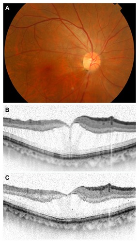 Figure 2 Case 4. Preoperative fundus photograph showing an inferotemporally located optic disc pit with associated maculopathy (A). Spectral-domain optical coherent tomography images through the macula obtained before (B) and 13 months after (C) the vitrectomy.