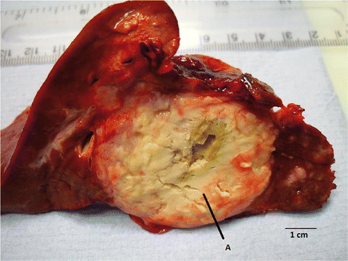 Figure 5. Macroscopic appearance of the ablation zone within tumour. The necrotic tumour tissue shows the edge of the ablation zone less clearly (A), although the antenna track is clearly visible within the tumour. Histological examination of the resected tumour showed apparently viable-looking adenocarcinoma within the ablation zone.