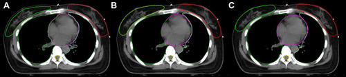 Figure 3 CTV and OAR contours generated by (A) GT, (B) U-ResNet, and (C) U-Net after breast conservative surgery.