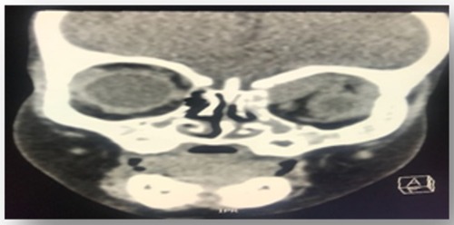 Figure 1 Non-enhanced coronal view CT of head and orbit, showing ill-defined soft tissue mass measuring about 2.7 cm, height 0.2 cm* transverse 1.3 cm located in the superomedial aspect of left orbit, extra-conal involving underlying bone erosion and periosteal reaction with opacification of left ethmoid and both maxillary sinuses.