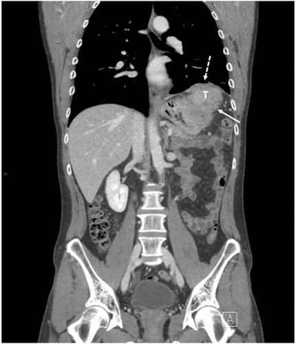 Figure 3. Pt #1: Coronal multi detector computer tomography(MDCT) shows the gastric tumour (T) in the left hypochondrium with infiltration of the left hemidiaphragma (stapled arrow) and the greater curvature (arrow) of the stomach.