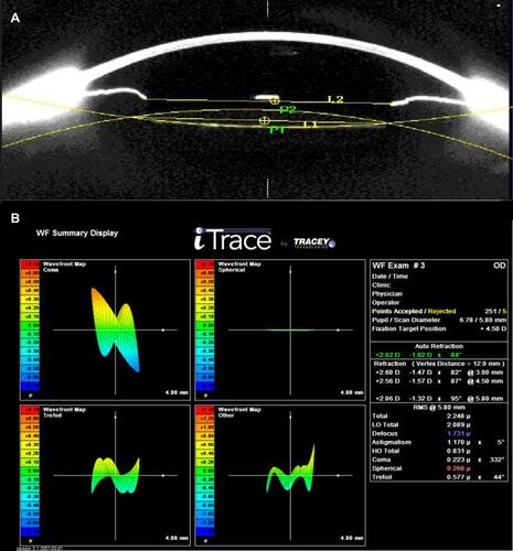 Figure 1 (A) IOL decentration and tilt were examined using the Pentacam® HR Scheimpflug system (Oculus, Wetzlar, Germany). (B) Coma was measured using the iTrace aberrometer (Tracey Technologies, Houston, TX, USA).