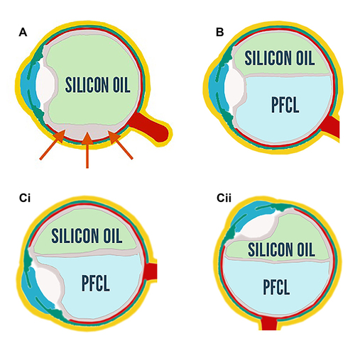 Figure 1 Schematic drawing representing the location of perfluorocarbon liquid and silicone oil in the vitreous cavity depending on the position of the head. (A) insufficient tamponade of the inferior retina with silicone oil only (B) Upright position head (Ci and Cii) tilted head. Note that superior and inferior retina are always tamponaded regardless of the position of the head.