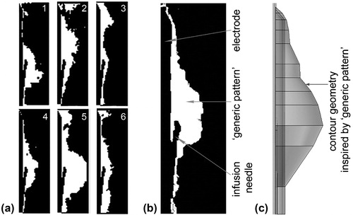 Figure 2. (a) Images of saline spatial distribution from the six saline injection trials (1 – 6) conducted on the in vivo model. Saline presence is shown in white, while electrode, infusion needles and noninfused tissue are in black. (b) “Generic pattern” of saline spatial distribution derived from the six images from (a) by thresholding and merging them into one greyscale image. (c) Contour geometry of saline-infused tissue derived from the “generic pattern” in (d) and used in the computer model.