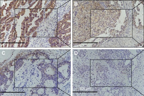Figure 1 The expression of PRDX1 in ovarian tissues (SP ×200, central SP ×400).