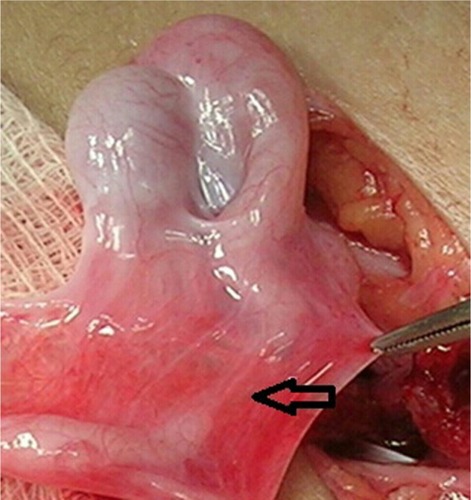 Figure 1 A defect in the continuity of the vas deferens near the epididymis.