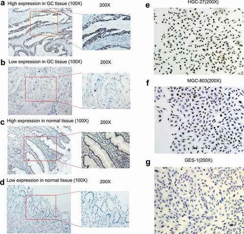 Figure 7. The expression level of TRPS1 protein in gastric cancer tissues and cells assessed by immunohistochemistry. (a, b) Expression of TRPS1 protein in gastric cancer tissue; (c, d) Expression of TRPS1 protein in normal gastric mucosa; (e) Expression of TRPS1 protein in HGC-27 gastric cancer cells; (f) Expression of TRPS1 protein in MGC-803 gastric cancer cells; (g) Expression of TRPS1 protein in normal GES-1 gastric mucosa cells. Magnification: 100X & 200X (a, b, c, d); 200X (e, f, g)