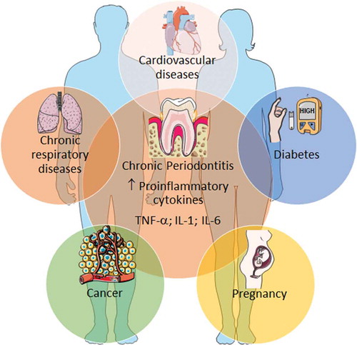 Figure 2. Chronic periodontitis and some common systemic diseases.Chronic periodontitis shares several associations with numerous chronic inflammatory diseases. Proinflammatory cytokines are, among other factors, important immune-related mediators involved in the disease pathogenesis. Only the most common noncommunicable diseases and pregnancy complications were exemplified, although others (rheumatoid arthritis, neurodegenerative disorders, etc.) exhibit also associations with chronic periodontitis. Illustration adapted medical elements from Servier Medical Art http://smart.servier.com/, with permission to reproduce under the Creative Commons Attribution 3.0 Unported License https://creativecommons.org/licenses/by/3.0/