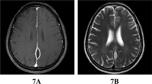 Figure 7 Cranial MR enhancement on September 23: Spindle-shaped ring enhancement was still visible in the region adjacent to the left cerebral falx and the left tentorium cerebelli, where abnormal signals were detected. In comparison to the previous MR, the extent of enhancement was diminished, and the original peripheral brain edema had dissipated. (A) The T1-enhanced scan shows spindle-shaped ring enhancement adjacent to the left side of the falx cerebri, with a reduction in size compared to the previous scan. (B) T2 sequence shows a high fusiform signal at the left side of the falx of the brain, which is smaller than before, and the primary peripheral cerebral edema is basically dissipated.