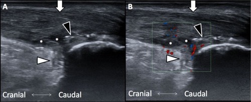 Figure 3 (A) Achilles tendon swelling, partial tear, and retrocalcaneal bursitis. (B) Increased blood flow in longitudinal view. Asterisks, tear site; black arrowhead, calcified lesions; white arrowhead, retrocalcaneal bursa; white arrow, Achilles tendon.