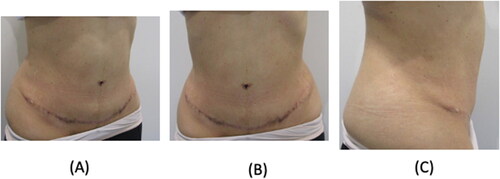 Figure 2. After four months postpartum, the patient is satisfied with her abdominoplasty results. It appears that the scars are less dark than they were during pregnancy. (A) Oblique view. (B) Frontal view. (C) Lateral view.