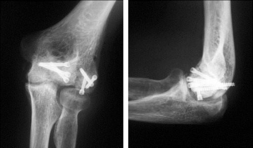 Figure 3.  Case 6. Anteroposterior and lateral radiographs taken 6 months after surgery showing minimal bone resorption of the capitellum, moderate lateral compartment osteoarthritis, and partial extrusion of a Herbert screw.