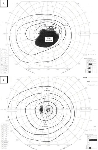 Figure 2 Rapid improvement of visual field defect.