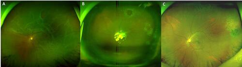Figure 2 A case of fortified barrier laser for rhegmatogenous retinal detachment (RRD). (A) Ultra-wide field fundus photograph demonstrates RRD in 63-year-old woman with a horseshoe tear and a small atrophic hole. (B) Fortified barrier laser was performed during vitrectomy surrounding two breaks. The flap of the horseshoe tear was removed. (C) The retina was maintained attached after resolution of the tamponade gas.