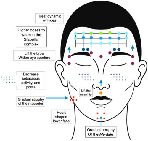 Figure 1 Treatment options for transgender facial feminization with BonTA.