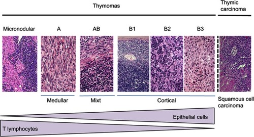 Figure 1 HES (Hematoxillin-Eosin-Safran) colorations of different subsets of thymic epithelial tumors, classified according to the World Health Organization classification.