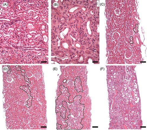 Figure 1. Representative histology of the tubular changes considered to be evidence of ATN (A) and (B) and of the four grades attributed to the lesion (C)–(F): (A) tubular dilatation, thinning of the tubular epithelium, interstitial edema; (B) cellular hyperchromatism, mitosis, and binucleation; (C) ATN grade 1: only rare tubules with evidence of necrosis are observed in the cortex; (D) ATN grade 2: small groups of necrotic tubules discontinuously distributed throughout the renal cortex; (E) ATN grade 3: groups of necrotic tubules are easily found in the renal cortex; (F) ATN grade 4: extensive areas of tubular necrosis are scattered throughout the renal cortex. ATN grade 0 (normal) not represented. Bar = (A), 50 μm; (B), 25 μm; and (C)–(F), 100 μm.