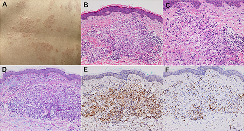 Figure 1 (A) Domed-shaped, mild indurated erythematous papules with smooth surfaces coalesced into irregular annular plaques. (B and C) Granulomatous infiltration includes mainly histiocytes, focally accumulated or dispersed between collagen bundles, (B) (HE×100), (C) (HE×200). (D) AB-PAS (+ focally and weakly, Special stain×200). (E) CD68 (KP-1, + IHC×100). (F) CD3 (+, IHC×100).