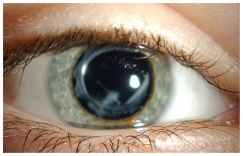 Figure 1 Case 4. Corneal scar following pencil injury. An intraocular lens is in situ.