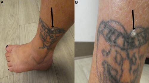 Figure 1 Tattoo-associated human papillomavirus infection. Distant (A) and closer (B) views of the left ankle of a 44-year-old woman show a verruca vulgaris (black arrow) that has developed on the black inked tattoo. She received her tattoo when she was 18 years old; the asymptomatic wart that developed within her tattoo appeared five years ago–26 years after tattoo inoculation–and subsequently increased in size. The patient’s tattoo-associated verruca vulgaris has been reported.15