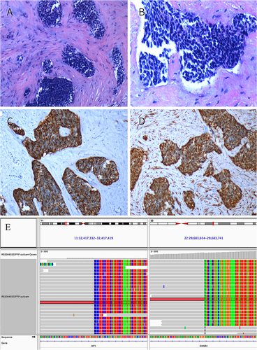 Figure 2 The pictures of tumor pathology sections: (A) HE×10, (B) HE×20, (C) EMA +, (D) vim +. (E) NGS of primary abdominal tumors showing WT-EWSR1 rearrangement. Burning Rock Dx, OncoScreen Plus Panel (Contains 520 genes).