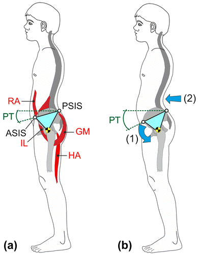 Figure 1. (a) Pivot model of anterior pelvic tilt, RA–rectus abdominis, IL–iliopsoas, GM–gluteus maximus, HA–hamstrings, PA–pelvic tilt angle, ASIS–anterior superior iliac spine, PSIS–posterior superior iliac spine. (b) Muscular imbalance leads to an increased anterior pelvic tilt (1) and an increased lumbar lordosis (2).