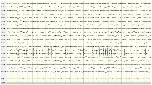 Figure 6. Five days after starting felbamate treatment. GPEDs disappear with the return of normal a background rhythm.