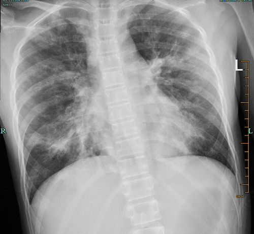 Figure 2 X-ray on the second day of admission: large patches of increased density shadow on both lungs with blurred edges.