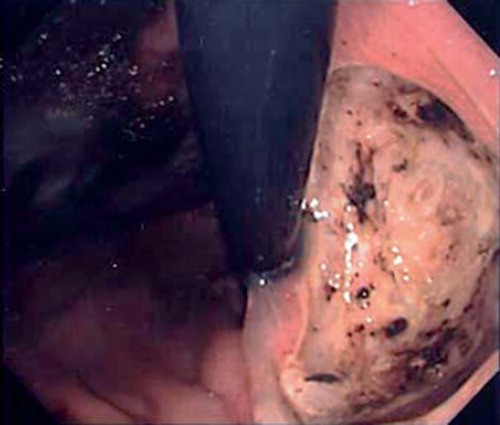 Figure 4. Findings from gastrofiberscopy at 2.5 months after SBRT. A large, deep ulcer with necrosis was found on the posterior wall of the upper gastric body. The location of the ulcer was almost in accordance with the area in the 90% isodose line.