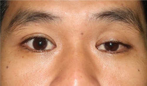 Figure 1 Primary position shows mild ptosis of the left eyelid with orthotropic ocular alignment.