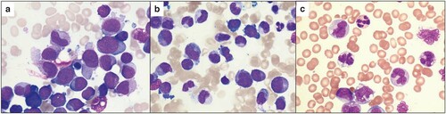Figure 1. Smears of bone marrow and peripheral blood. (a) Bone marrow aspirates at relapse showed proliferation of blasts. (b) Bone marrow aspirates at day 169 showed proliferation of blasts with promonocytic differentiation. (c) Increase of abnormal monocytes with convoluted or folded nuclei in peripheral blood smears at day 169.