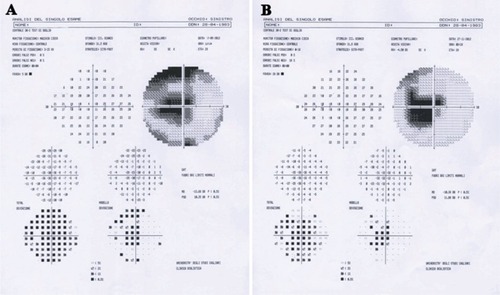 Figure 4 Visual field of the left eye (SITA-Fast Central 30-2 strategy) immediately (A) and after 3 months (B) since CRA occlusion.